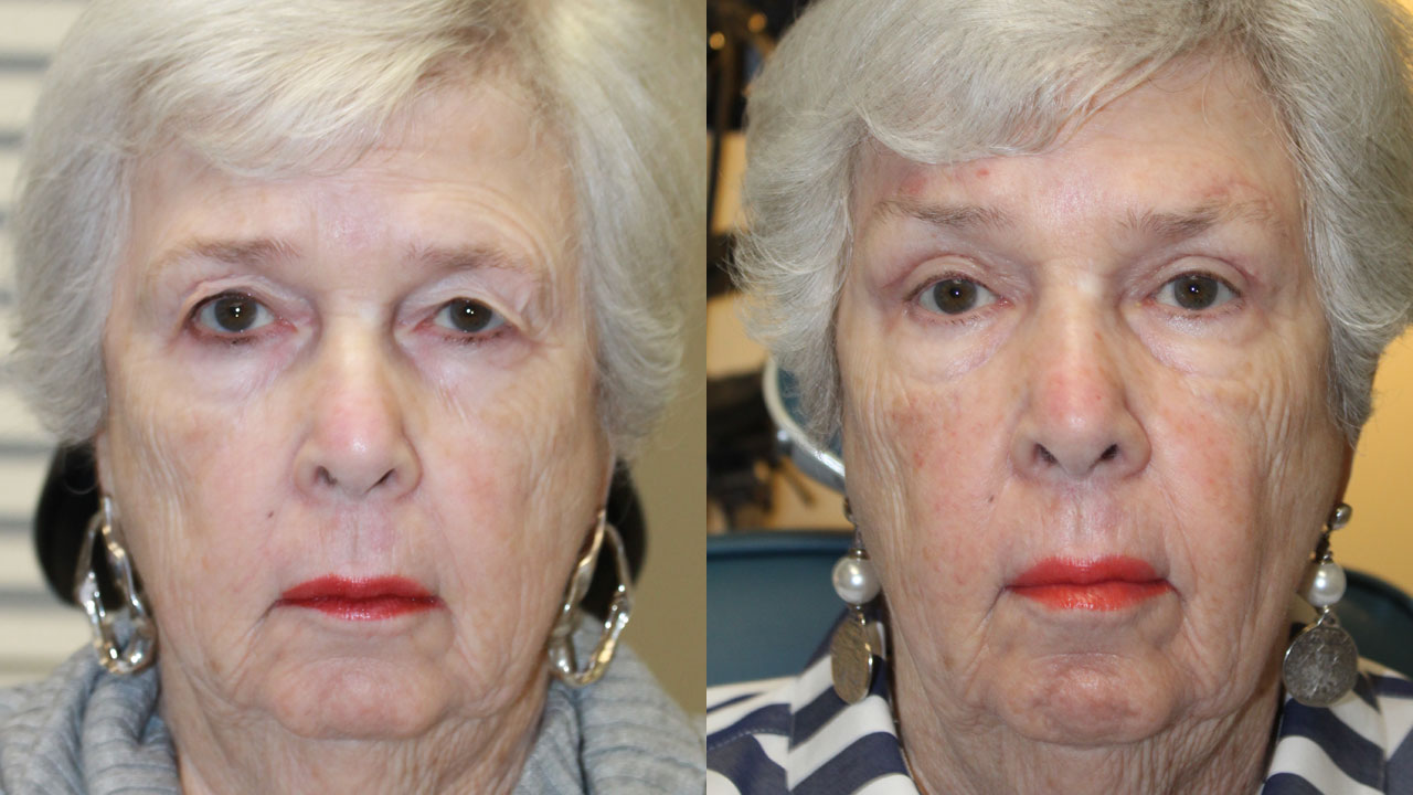 Blepharoplasty with Direct Brow Lift