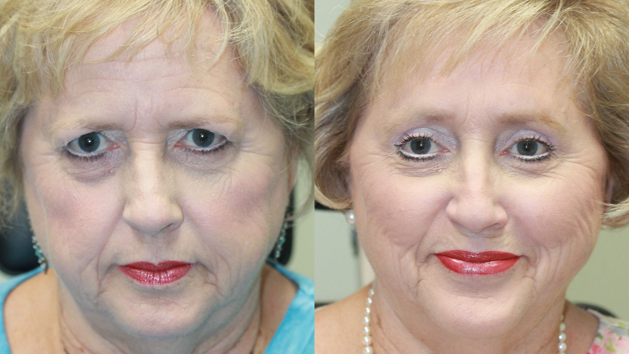 Blepharoplasty with Endoscopic Forehead Lift