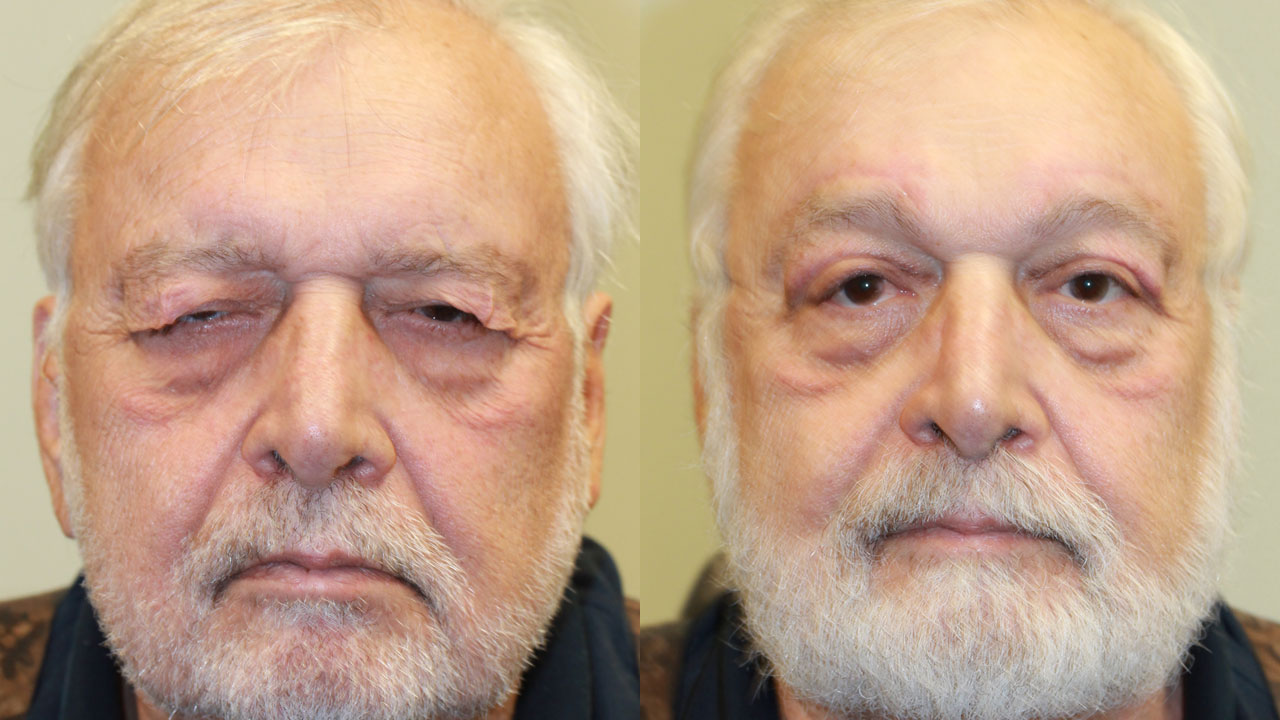 Blepharoplasty with Posterior Ptosis