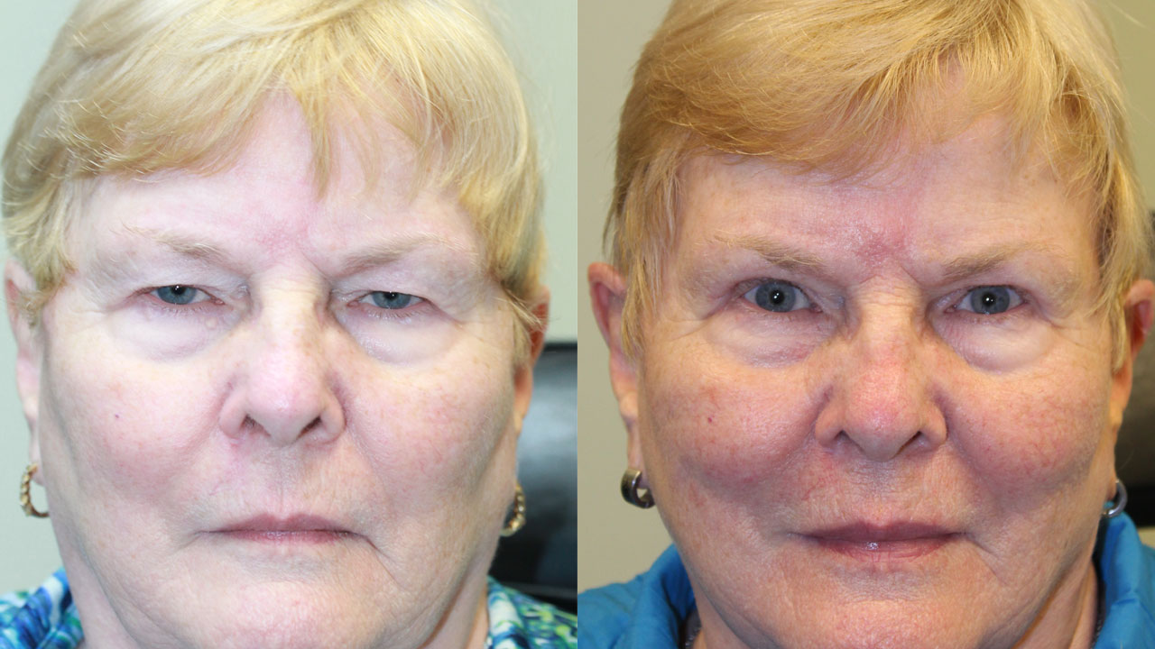 Blepharoplasty with AP & Excision of Lesion